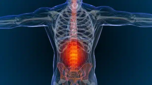 Severe spinal injury shown as an x-ray.