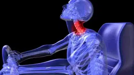 Can I Get Compensation for Whiplash in a Car Accident?